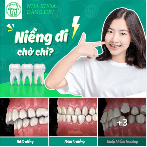 NIỀNG NGAY ĐI CÒN CHỜ CHI?