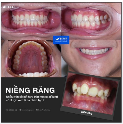 Niềng răng cho trường hợp bị NHIỀU VẤN ĐỀ KẾT HỢP có phức tạp và kéo dài hơn không?