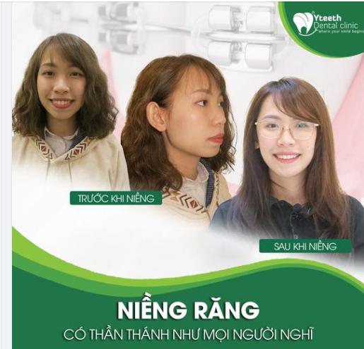 NIỀNG RĂNG CÓ THẦN THÁNH NHƯ MỌI NGƯỜI NGHĨ
