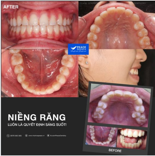 NIỀNG RĂNG CÓ THỂ NHANH HƠN BẠN NGHĨ!