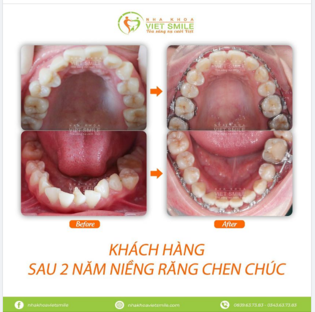 NIỀNG RĂNG ĐÃ THAY ĐỔI THẾ NÀO