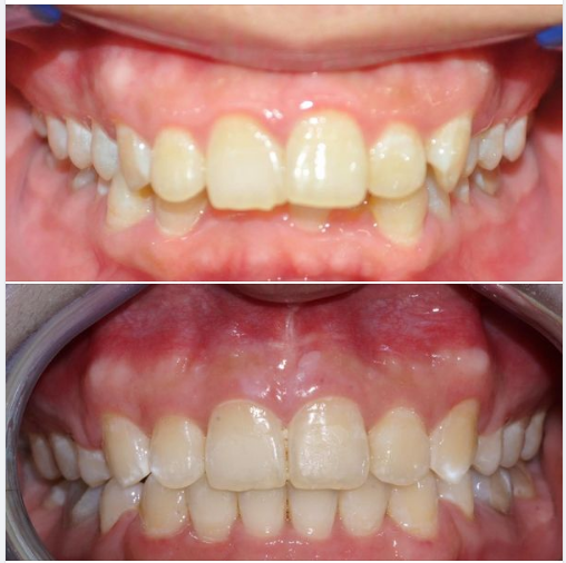 Niềng răng, đẹp hay không đẹp là còn ở chi tiết: kỹ lưỡng, chính xác từng chút một