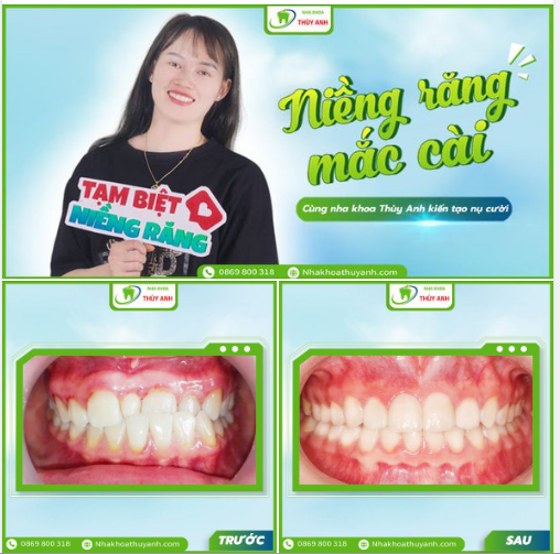 NIỀNG RĂNG GIÁ TỐT - TRẢ GÓP CHỈ TỪ 4 TRIỆU/HÀM