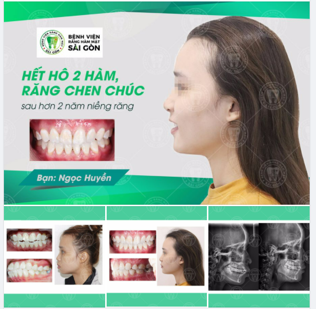 NIỀNG RĂNG giải quyết tình trạng cắn đối đầu, hô hai hàm, chen chúc cho bạn Ngọc Huyền tại Hệ thống Nha Khoa Đăng Lưu