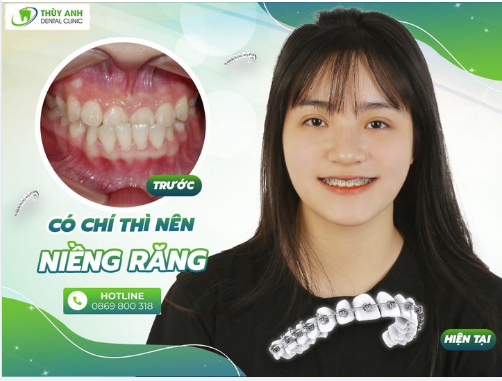 NIỀNG RĂNG HÔM NAY HẾT NGAY CẮN NGƯỢC