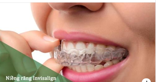 NIỀNG RĂNG INVISALIGN GIÁ BAO NHIÊU TIỀN?