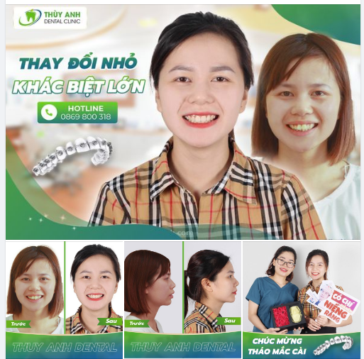 NIỀNG RĂNG KHẤP KHỂNH - THAY ĐỔI NHỎ KHÁC BIỆT LỚN