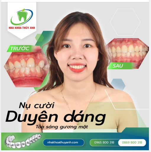 NIỀNG RĂNG KHÔNG ĐÁNG SỢ, ĐÁNG SỢ LÀ KHÔNG QUYẾT ĐỊNH NIỀNG RĂNG SỚM HƠN