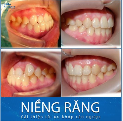 NIỀNG RĂNG KHỚP CẮN NGƯỢC BAO LÂU? YẾU TỐ NÀO QUYẾT ĐỊNH THỜI GIAN