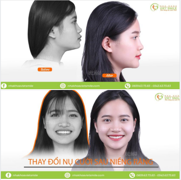 NIỀNG RĂNG “LÃI” NGAY GÓC NGHIÊNG THẦN THÁNH