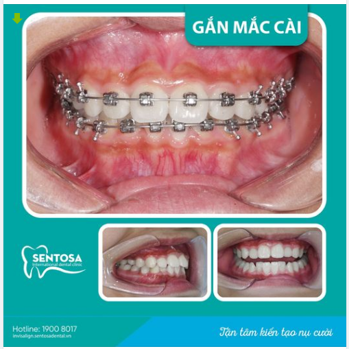 NIỀNG RĂNG MẮC CÀI – GIẢI PHÁP TỐI ƯU CẢI THIỆN NỤ CƯỜI