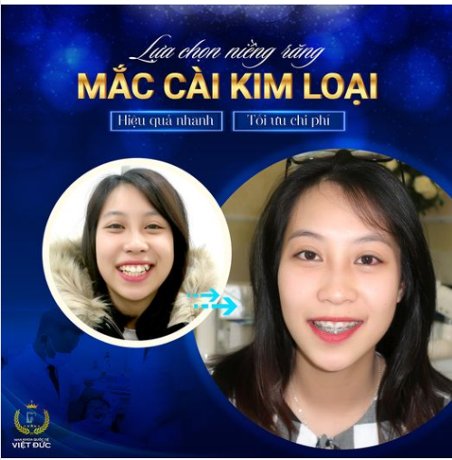 Niềng răng mắc cài kim loại là phương pháp khắc phục hiệu quả tình trạng răng lệch lạc tối ưu, tiết kiệm chi phí so với phẫu thuật gây xâm lấn.