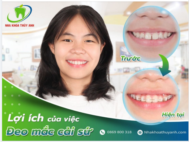 NIỀNG RĂNG MẮC CÀI SỨ LỰA CHỌN HOÀN HẢO VỀ THẨM MỸ