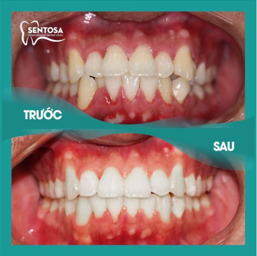NIỀNG RĂNG MẮC CÀI, TẠI SAO KHÔNG