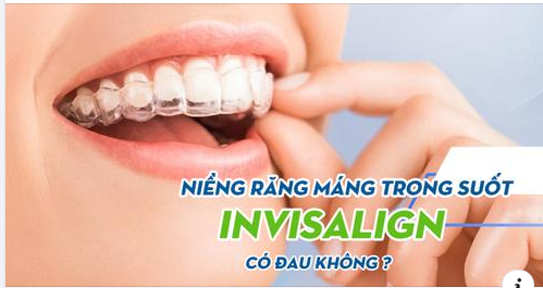 NIỀNG RĂNG MÁNG TRONG SUỐT CÓ ĐAU KHÔNG? CÓ HIỆU QUẢ KHÔNG?
