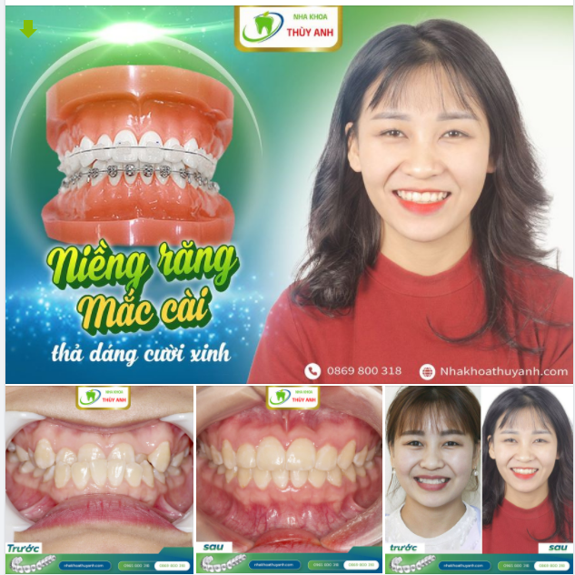 NIỀNG RĂNG MINH BẠCH CHI PHÍ CƯỜI ĐẸP NHƯ Ý