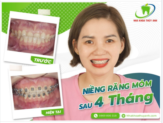 NIỀNG RĂNG MÓM KHÔNG NGẠI TUỔI TÁC CÙNG NHA KHOA THÙY ANH