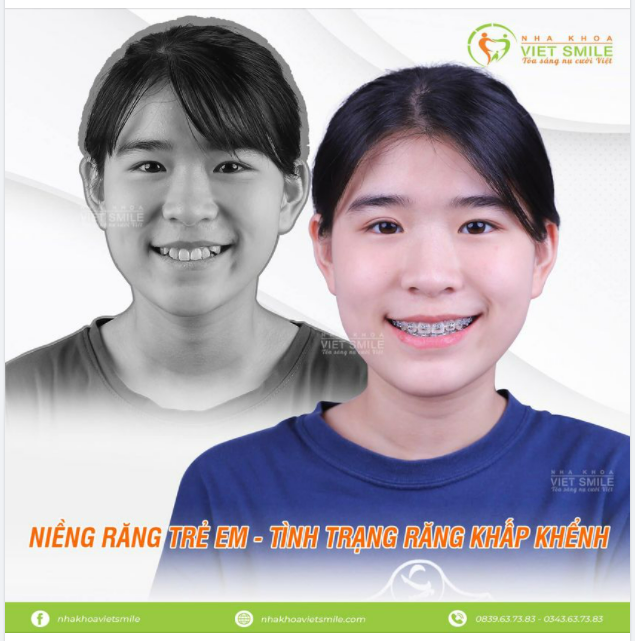 NIỀNG RĂNG - MÓN QUÀ VÔ GIÁ MÀ CHA MẸ DÀNH CHO CON.