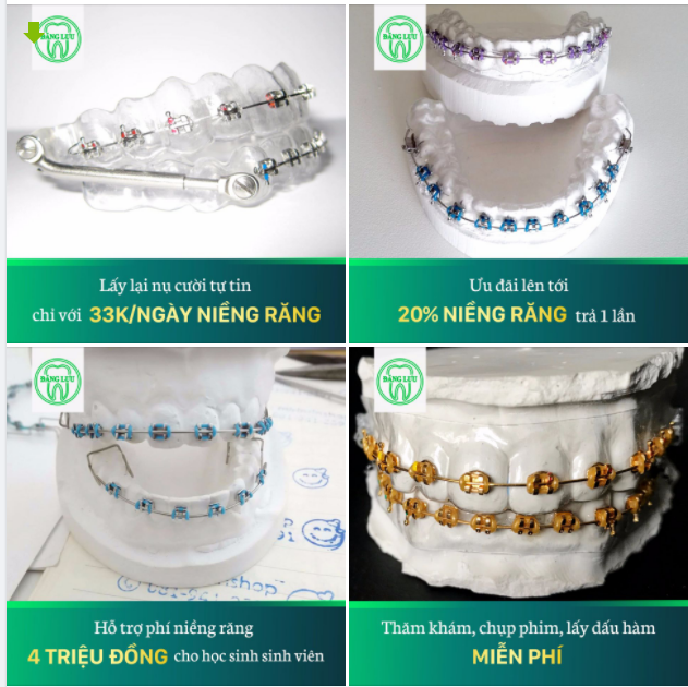 NIỀNG RĂNG SIÊU ƯU ĐÃI chỉ 990k/tháng tại Nha Khoa Đăng Lưu! Giảm 4 triệu dành riêng cho học sinh viên!