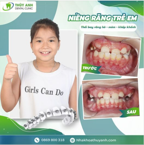 NIỀNG RĂNG SỚM CHO TRẺ - THỜI ĐIỂM VÀNG CHO NỤ CƯỜI MỚI