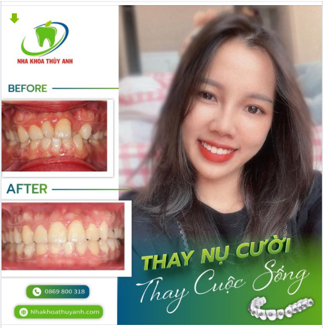 NIỀNG RĂNG THAY ĐỔI ĐẾN THẾ NÀO BẠN ĐÃ THỬ CHƯA?