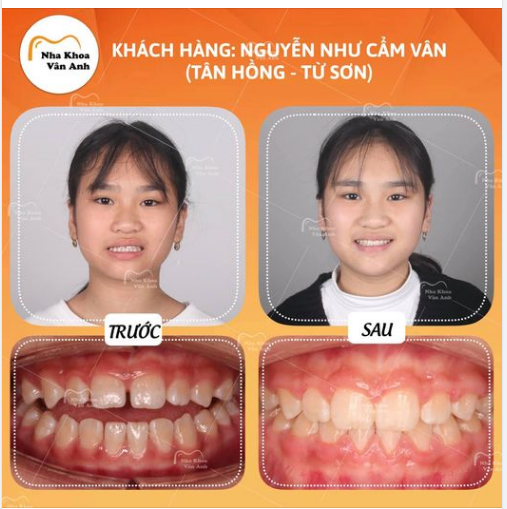 NIỀNG RĂNG TRẢ GÓP CHỈ TỪ 5 TRIỆU CHO CẢ 2 HÀM CÓ ĐẢM BẢO KHÔNG?