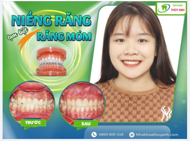 NIỀNG RĂNG TRẢ GÓP CHỈ TỪ 8 TRIỆU.