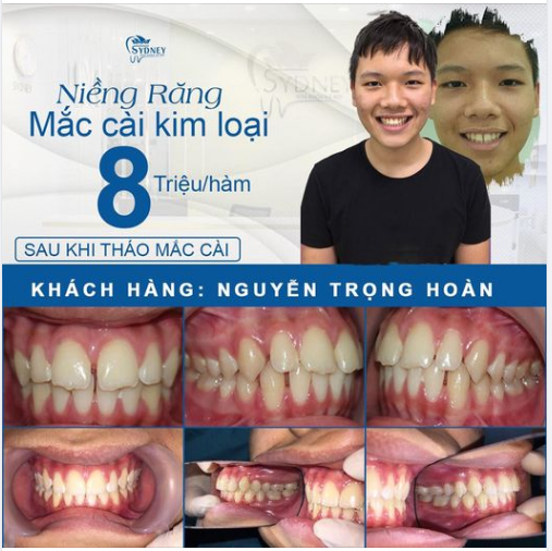 NIỀNG RĂNG VỪA TIẾT KIỆM VỪA HIỆU QUẢ