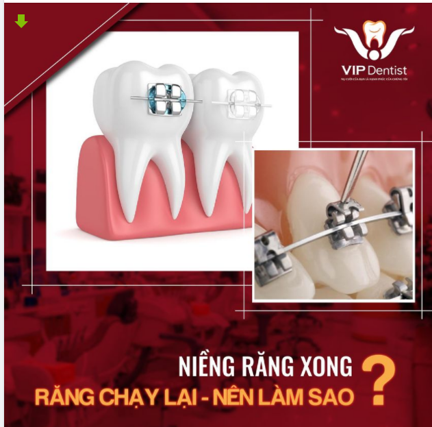 NIỀNG RĂNG XONG - RĂNG CHẠY LẠI - NÊN LÀM SAO