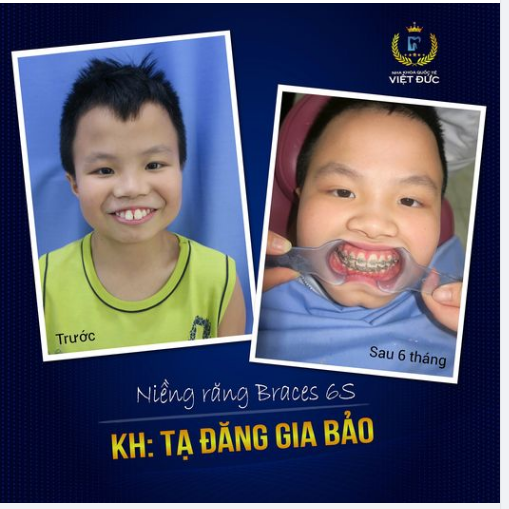 Nụ cười đẹp là khởi đầu cho một tương lai tươi sáng. Niềng răng cho con càng sớm, đẹp càng sớm, tự tin càng sớm.