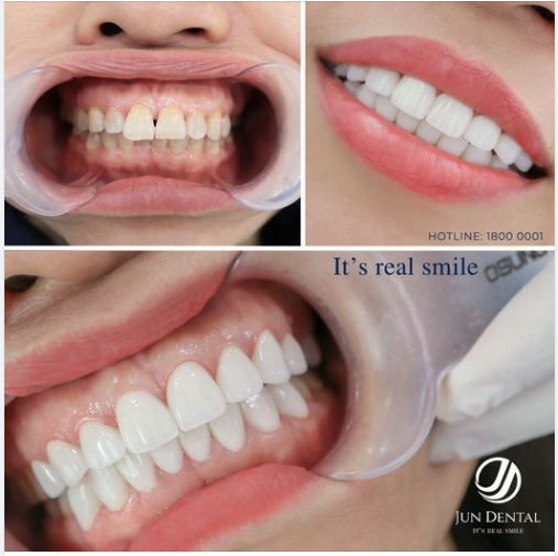 Nụ cười hoàn mỹ của ca 18 răng sứ cao cấp Zirtec dành cho khách hàng 47 tuổi