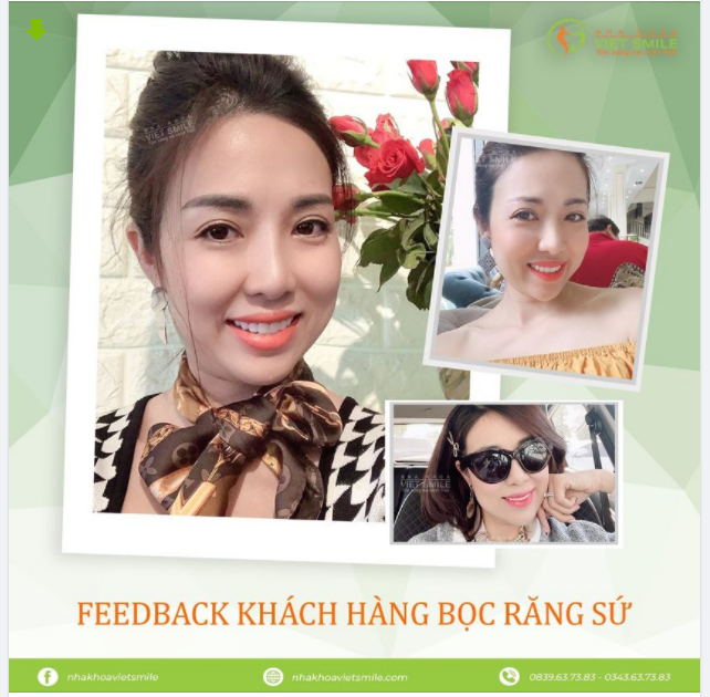 Nụ cười khách hàng sau 4 năm bọc sứ tại nha khoa Việt Smile.