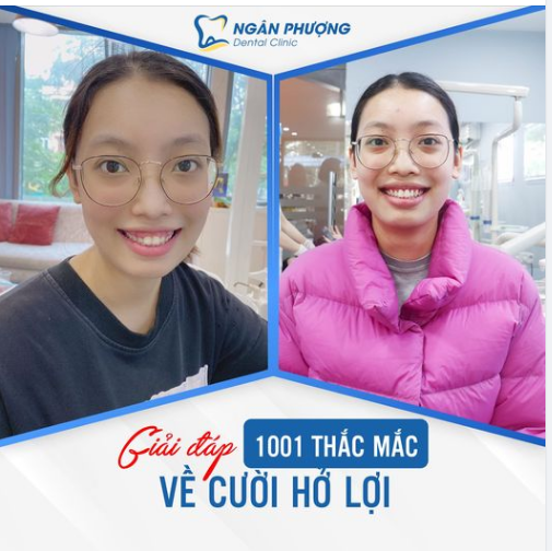 PHẪU THUẬT CƯỜI HỞ LỢI VÀ NHỮNG ĐIỀU CẦN BIẾT