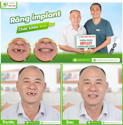 PHỤC HÌNH 2 RĂNG CỬA MẤT CHO BÁC KHÁCH HÀNG BẰNG CẤY GHÉP IMPLANT
