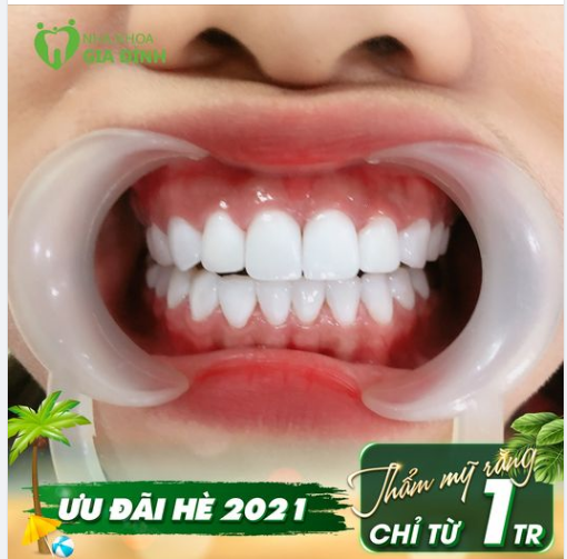 ️Phục hình thẩm mỹ răng sứ - Giải pháp vàng cho nụ cười nhiều khuyết điểm của bạn