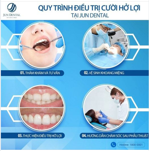 Quy trình điều trị cười hở lợi tại Nha khoa Jun Dental