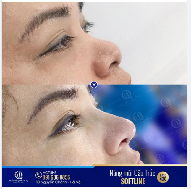 Quyết định nâng mũi - quyết định đặt niềm tin vào Bs Vũ Quang