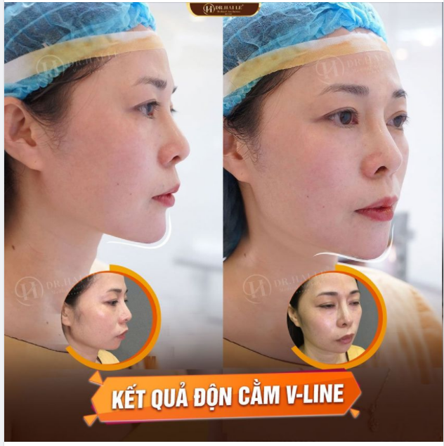 QUYẾT KHÔNG ĐỂ “CẰM LẸM” DÌM HÀNG GƯƠNG MẶT, KHÁCH HÀNG ĐẾN DR.HẢI LÊ ĐỘN CẰM V- LINE