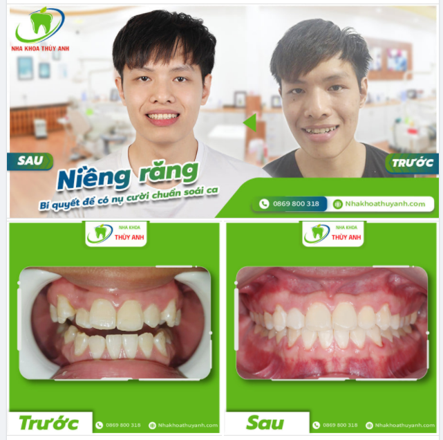 QUYẾT TÂM NIỀNG RĂNG ẮT CÓ HÀM RĂNG ĐẸP