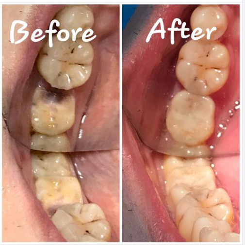 Răng bị sâu vỡ lớn, nhưng không muốn bọc thì làm gì