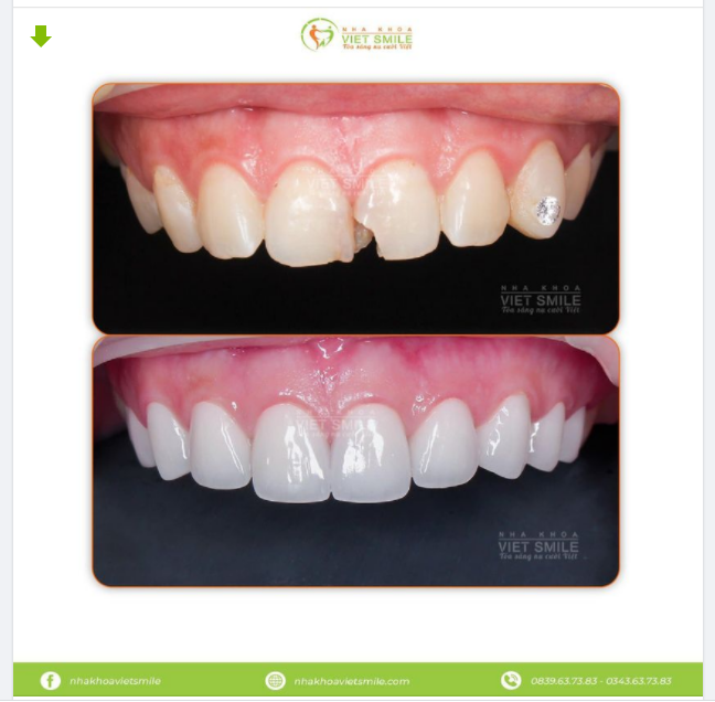 RĂNG CỬA BỊ MẺ CẦN LÀM GÌ ĐỂ KHẮC PHỤC