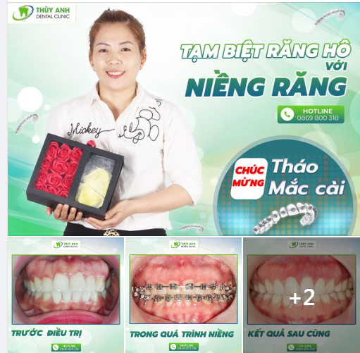 RĂNG ĐẸP BẤT CHẤP TUỔI TÁC SAU NIỀNG RĂNG HÔ, KHẤP KHỂNH