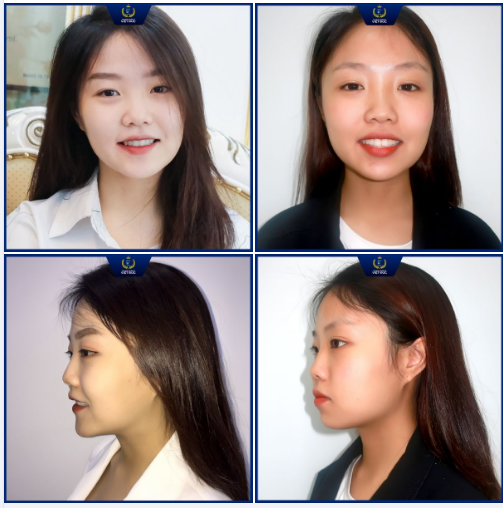 RĂNG ĐỀU CƯỜI XINH RẠNG RỠ NGÀY THÁO MẮC CÀI CHỈNH NHA