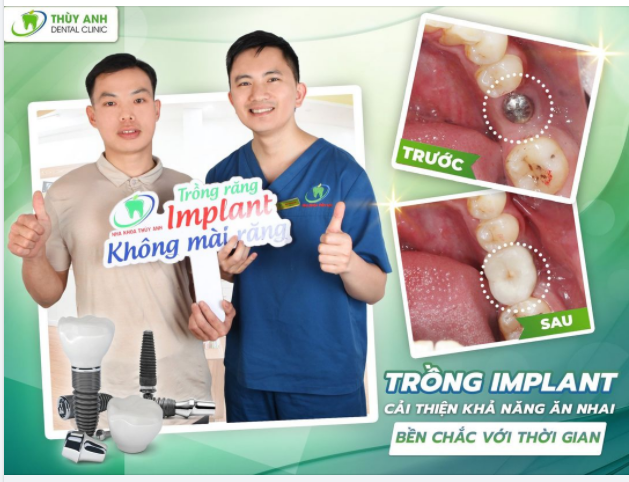 RĂNG IMPLANT TỐI ƯU ĂN NHAI - TỐI ƯU THẨM MỸ