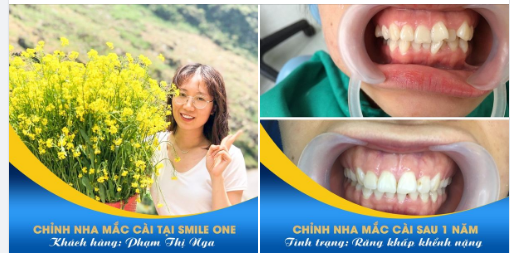 RĂNG KHẤP KHỂNH QUÁ THÌ PHẢI LÀM SAO???