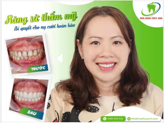 RĂNG NHIỄM MÀU, CÓ KHE THƯA - THẨM MỸ RĂNG SỨ GIẢI PHÁP HOÀN HẢO