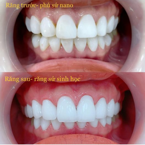 Răng phủ sứ nano đúng là rẻ, nhanh và thay đổi màu sắc đúng với mong muốn của đại đa số những người yêu cái đẹp.