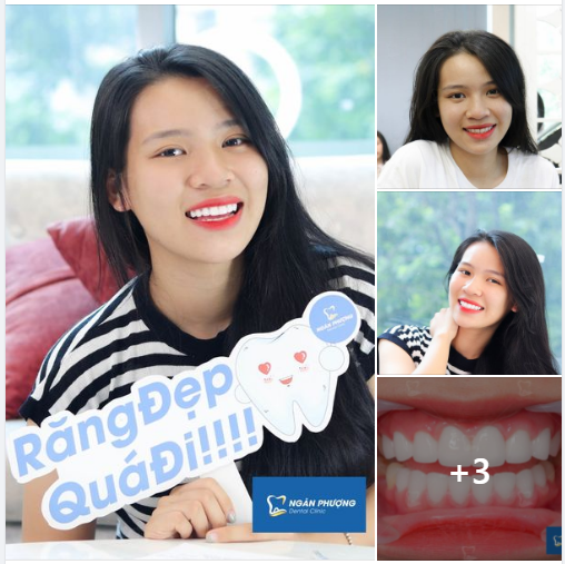 RĂNG SÁNG ĐẸP XINH - NỤ CƯỜI LUNG LINH