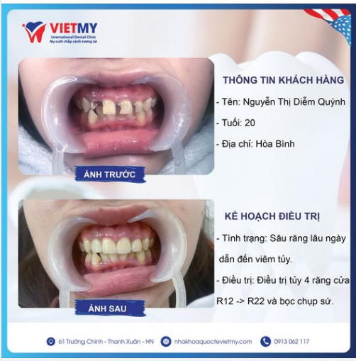 Răng sâu lâu ngày không điêu trị dẫn đến viêm tủy xử lý thế nào ?