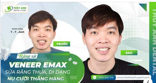 RĂNG SỨ CÓ BỊ XUỐNG MÀU THEO THỜI GIAN KHÔNG?